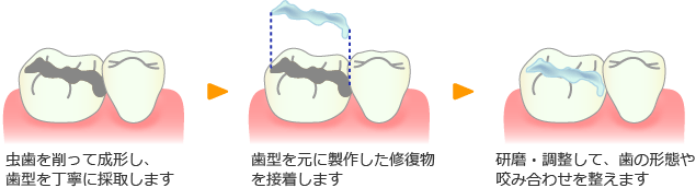 インレー修復法