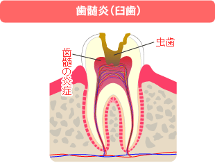 歯髄炎（臼歯）