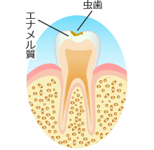 Ｃ１：エナメル質の虫歯