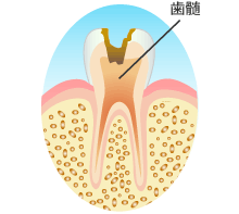 Ｃ３：歯髄（歯の神経）の虫歯