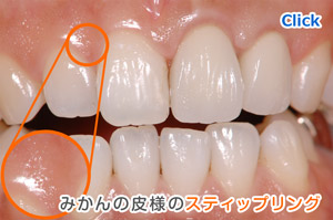 審美歯科 エマージェンスプロファイル獲得までの治療例  術後５～６ヶ月