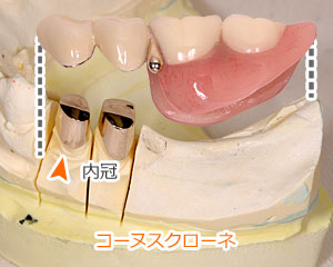 コーヌスクローネ − 部分入れ歯