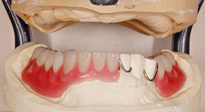 上下顎チタン床義歯製作