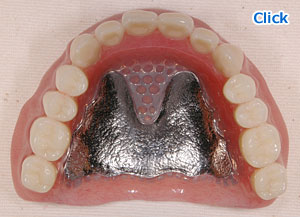 上顎のチタン床の総義歯
