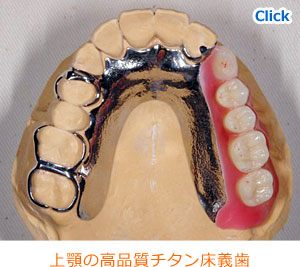 上顎の高品質チタン床義歯