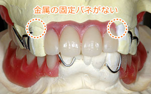 上顎前歯に金属の固定バネがないチタン床部分入れ歯