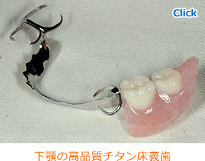 下顎の高品質チタン床義歯