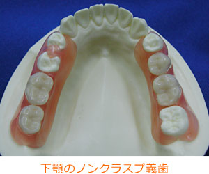下顎のノンクラスプ義歯