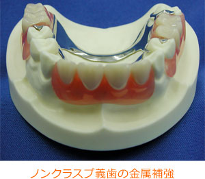 ノンクラスプ義歯の金属補強