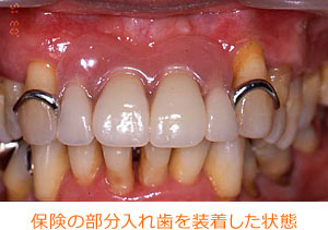 保険の部分入れ歯を装着した状態