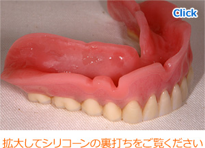 シリコーン義歯