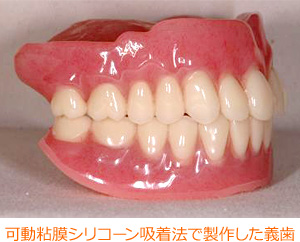 可動粘膜シリコーン吸着法で製作した義歯