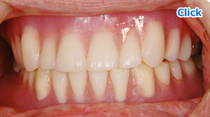 当院でシリコーン義歯をつくられた患者様の例：治療前