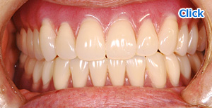 当院でシリコーン義歯をつくられた患者様の例：治療後