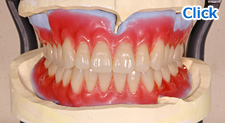 シリコーン義歯製作ステップ３：噛み合わせの設計（咬合採得）