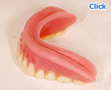 シリコーン義歯製作ステップ６：やわらかい入れ歯（ループシリコンデンチャー）の完成