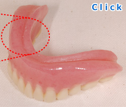 顎堤がほとんどない場合の入れ歯快適な義歯の製作が困難な状態です