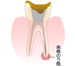 歯根のう胞摘出術